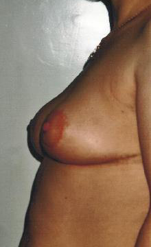 Podniesienie piersi - po operacji Podniesienie piersi - po operacji