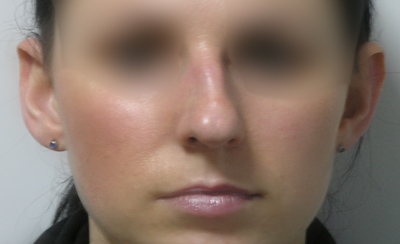 Przed operacjÄ… Przed operacjÄ…