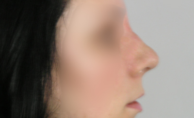 Po operacji Po operacji