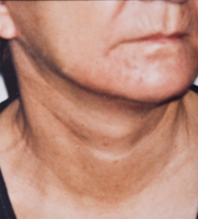 Usunięcie zmarszczek twarzy i szyi - po Usunięcie zmarszczek twarzy i szyi - po