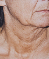 Usunięcie zmarszczek twarzy i szyi - przed Usunięcie zmarszczek twarzy i szyi - przed